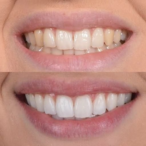 Antes e depois de limpeza dental — Dentes livres de tártaro e manchas