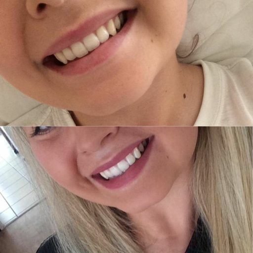 Antes e depois de limpeza dental — Hálito fresco e gengiva saudável