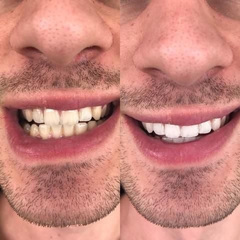 Antes e depois de limpeza dental — Prevenção que evita problemas maiores