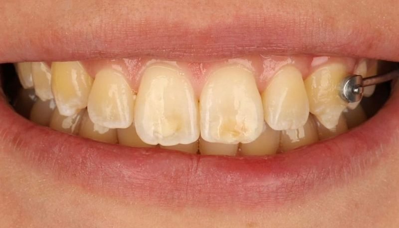 Antes da limpeza dental — caso 1
