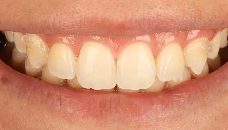 Depois da limpeza dental — caso 1