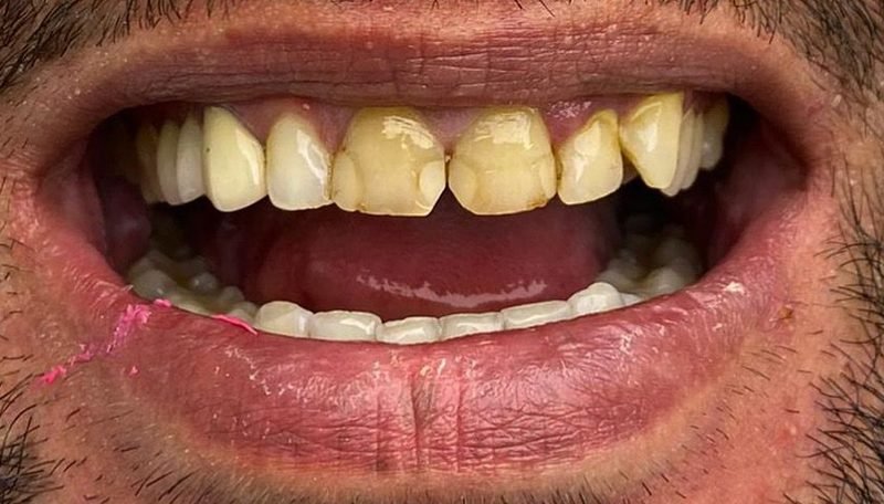 Antes da limpeza dental — caso 2