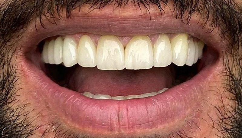 Depois da limpeza dental — caso 2