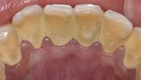 Antes da limpeza dental — caso 3