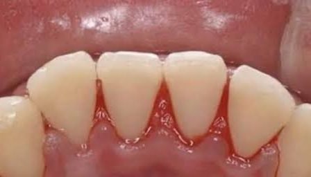 Depois da limpeza dental — caso 3