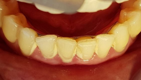 Antes da limpeza dental — caso 4