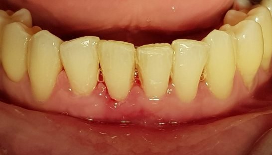 Depois da limpeza dental — caso 4